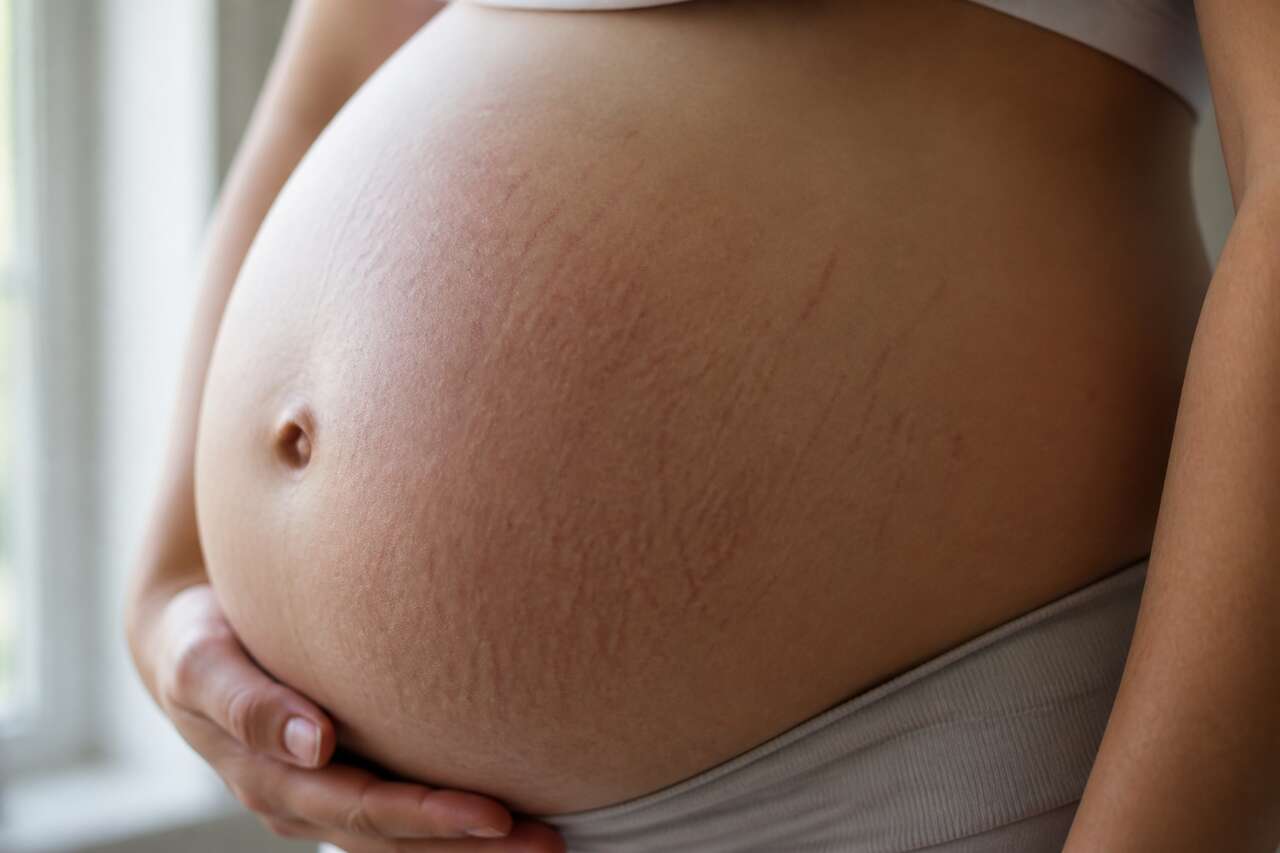 Comprendre l'origine des vergetures de grossesse
