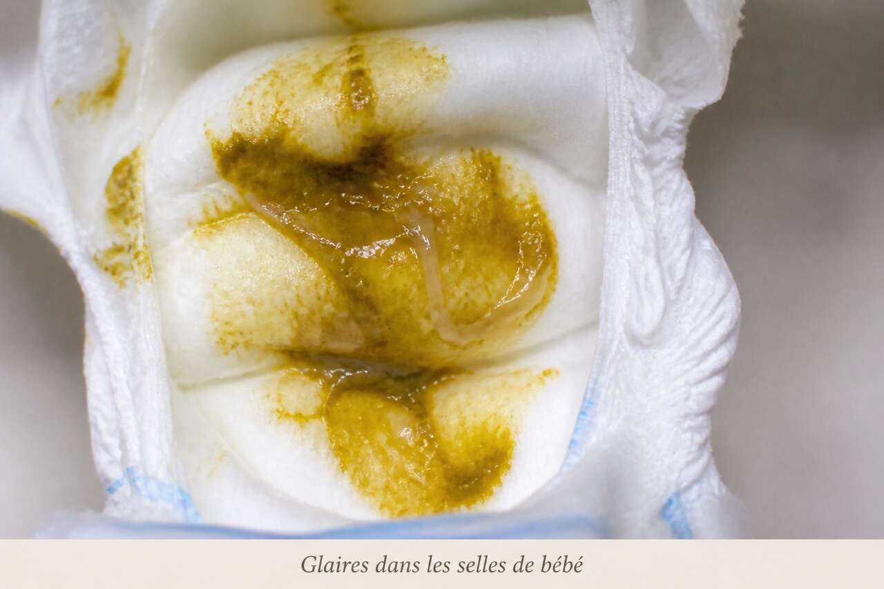 Causes fréquentes des selles glaireuses chez bébé Causes fréquentes des selles glaireuses chez bébé